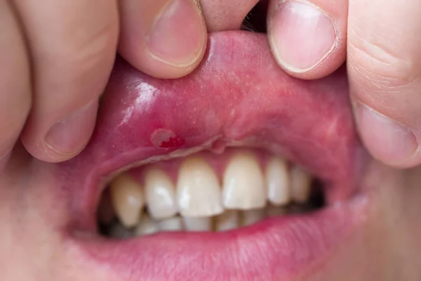 Nahaufnahme von Stomatitis in den Mund lizenzfreie Stockbilder