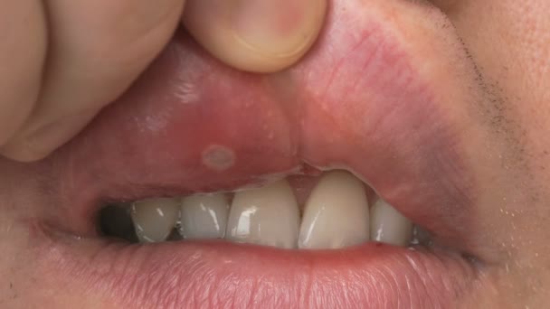 Stomatitis in mond. Close-up — Stockvideo