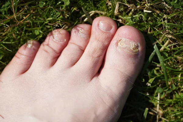 Onicomicosis. La infección fúngica de las uñas de los pies Imagen de archivo