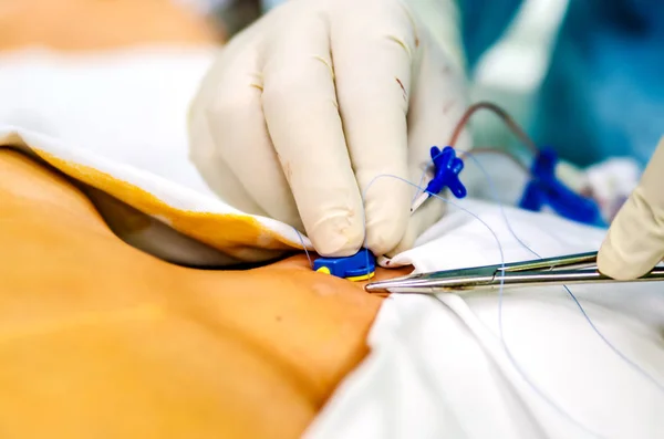 Der Prozess der Fixierung des zentralen Katheters durch Nähen mit medizinischen Fäden. — Stockfoto