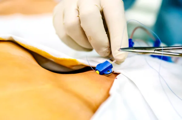 Der Prozess der Fixierung des zentralen Katheters durch einen Anästhesisten durch Nähen. — Stockfoto