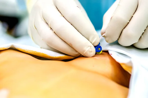 O anestesiologista completa o estadiamento do cateter central antes da operação . — Fotografia de Stock