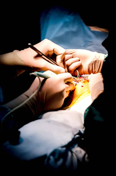 O processo de realização de um corte do tórax durante a cirurgia cardíaca . — Fotografia de Stock