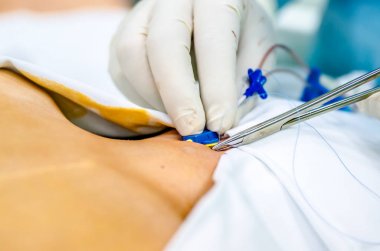 Böylece tamir Merkezi kateter anestezist doktor diker.