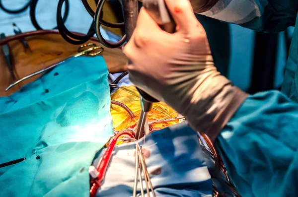 Cirurgião Elimina Fibrilação Durante Cirurgia Cardíaca Usando Desfibrilador — Fotografia de Stock
