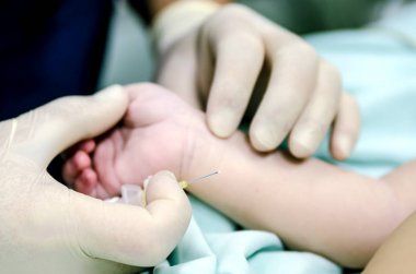 Anestezi uzmanı bir iğneden kateter elinde tutuyor. Doktor operasyon öncesi periferik yemek servisi ayarlamak için bir damar gropes.
