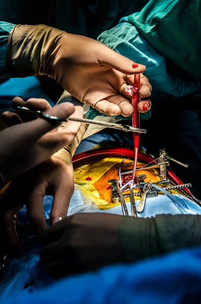 Cánula Llena Del Dispositivo Circulación Artificial Las Manos Del Cirujano — Foto de Stock