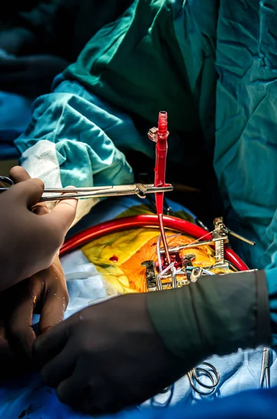 Cánula Quirúrgica Del Aparato Circulación Artificial Sujeta Por Cirujano — Foto de Stock
