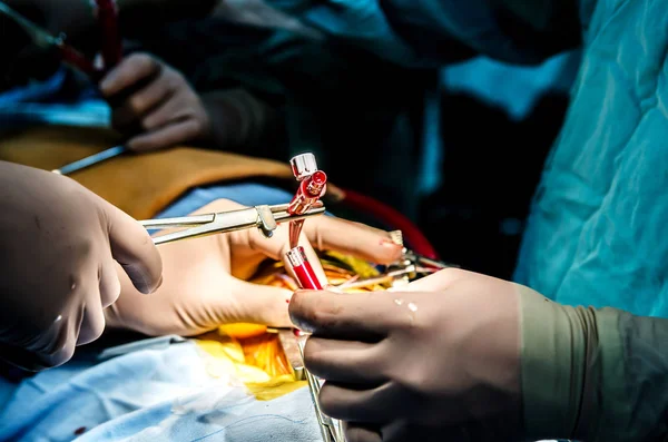 外科医生在心脏手术中将病人与人工循环装置连接起来 — 图库照片