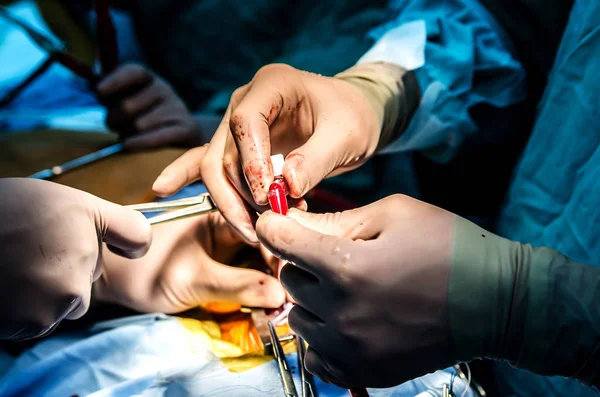 Процес Підключення Пацієнта Апарату Штучного Кровообігу Під Час Операції Серці — стокове фото
