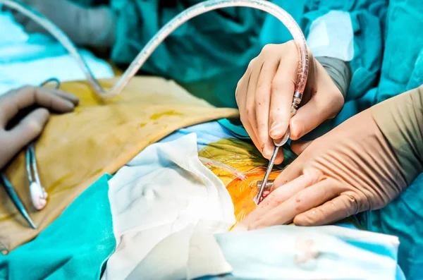 Cirurgião Remove Excesso Líquido Depois Que Uma Ferida Derramada Com — Fotografia de Stock