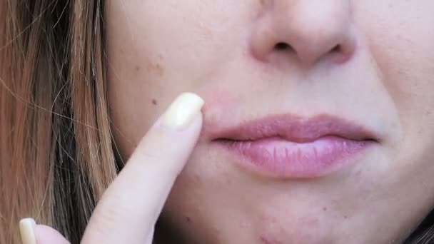 Blonde woman scratching a sore blister on the side of the mouth — Αρχείο Βίντεο