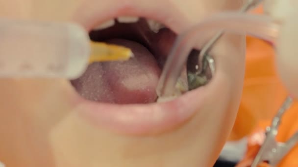 O dentista usando seringa nos dentes de uma criança — Vídeo de Stock