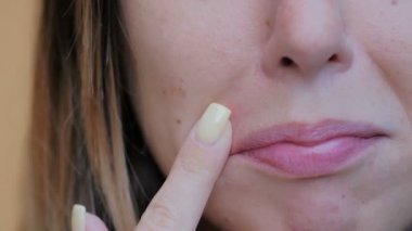 young woman scratches a bubble near the mouth