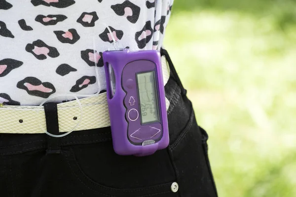 Şeker hastası bir kız çocukluk diyabeti konsepti olan insülin pompası uyguluyor. — Stok fotoğraf