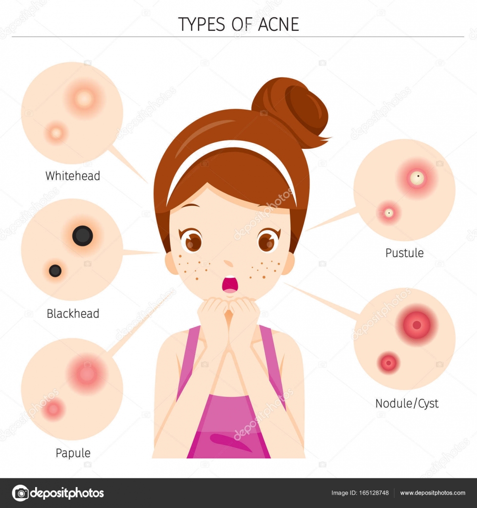 Acne Types And Girl With Acne On Face Stock Vector C Matoommi