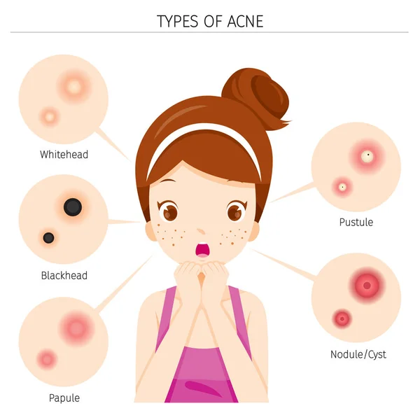 Types van acne en meisje met Acne op het gezicht — Stockvector