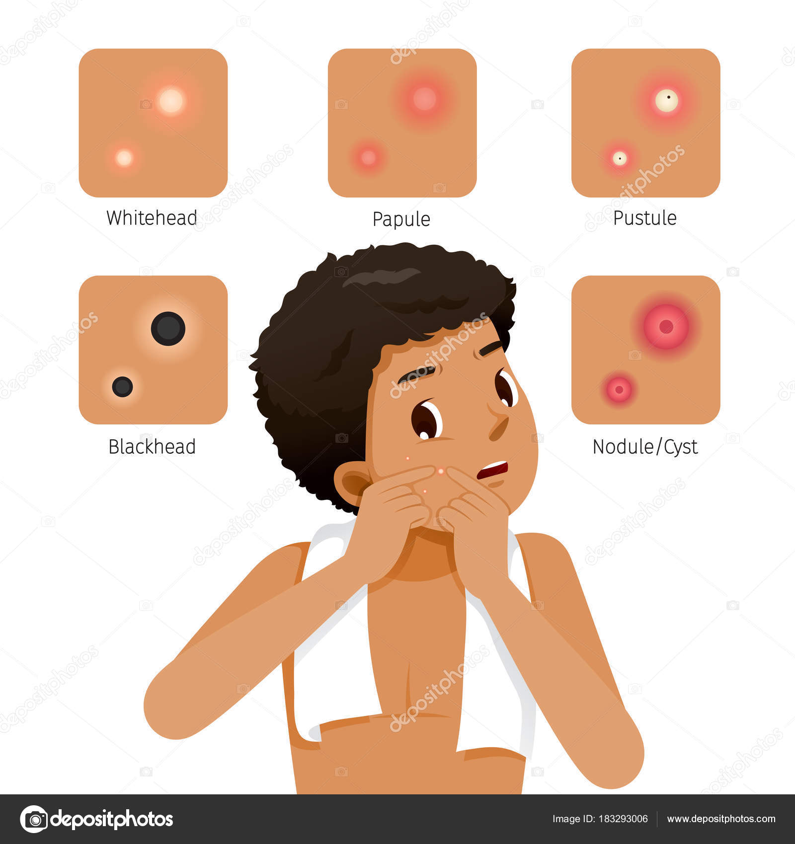 Acne Types And Tanned Skin Man With Acne On Face Stock Vector C Matoommi