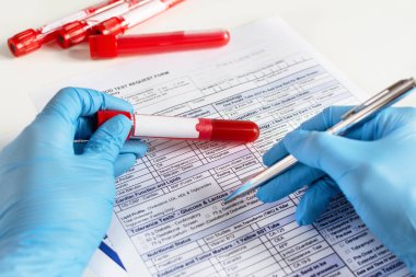 Doktorun eli kırmızı kan tüpünü kan örneğiyle tutuyor ve test sonuçlarıyla dolduruyor..