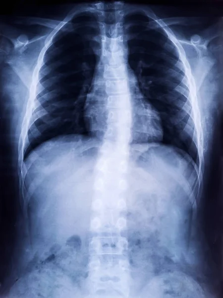 X-Ray Film of Human Spine Scoliosis for Medical Diagnosis — Stock Image X-Ray Film of Human Spine Scoliosis for Medical Diagnosis Royalty Free Stock Images