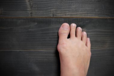 Bunion in foot clipart