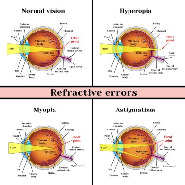 Refractive errors eyeball: hyperopia, myopia, astigmatism. clipart