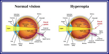 Refractive errors eyeball. Hyperopia. clipart