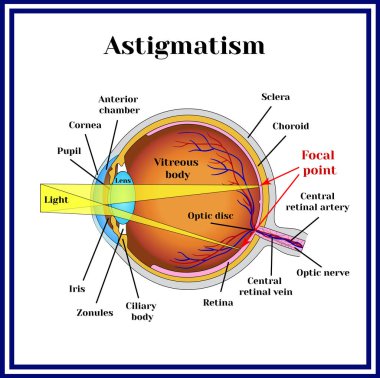 Refractive errors eyeball. Astigmatism. clipart