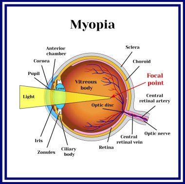 Refractive errors eyeball. Myopia. clipart