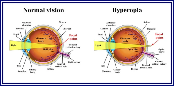 Erros refrativos globo ocular. Hipermetropia . —  Vetores de Stock