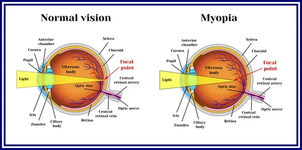 Erros refrativos globo ocular. Miopia . —  Vetores de Stock