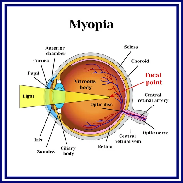 Erros refrativos globo ocular. Miopia . —  Vetores de Stock