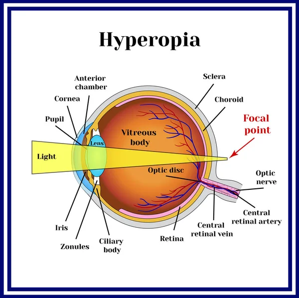 Erros refrativos globo ocular. Hipermetropia . — Vetor de Stock