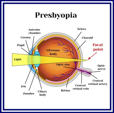 Refractive errors eyeball. Presbyopia. clipart