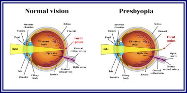 Refractive errors eyeball. Presbyopia. clipart