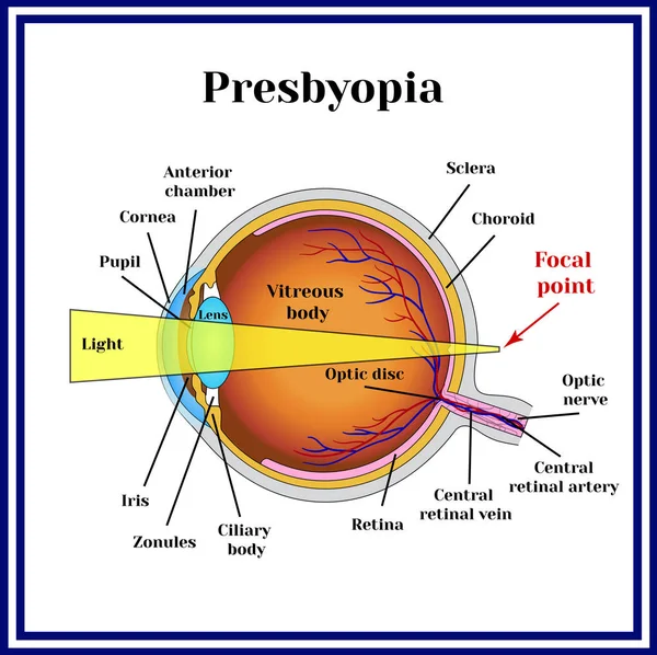 Refractieve fouten de oogbol. Presbyopie. — Stockvector