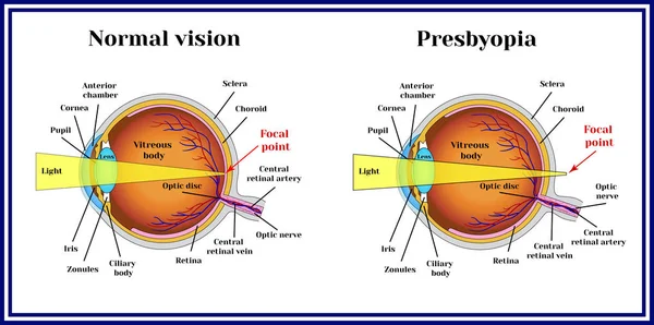 Ошибки преломления глазного яблока. Пресбиопия . — стоковый вектор