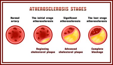 Atherosclerosis stages. Cholesterol plaques. clipart