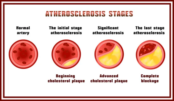 Etapas de aterosclerosis. Placas de colesterol . — Vector de stock