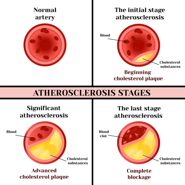 Atherosclerosis stages. Cholesterol plaques. — Stock Vector