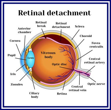 Retinal detachment. Disease. clipart