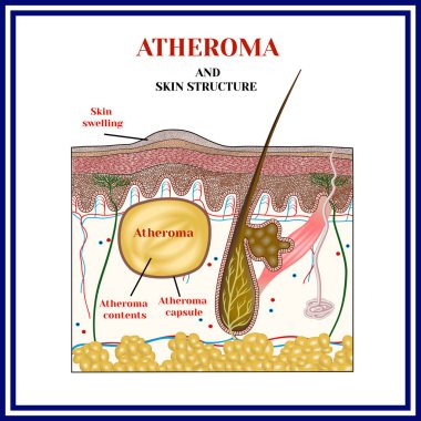 Atheroma. Cysts, tumors. clipart