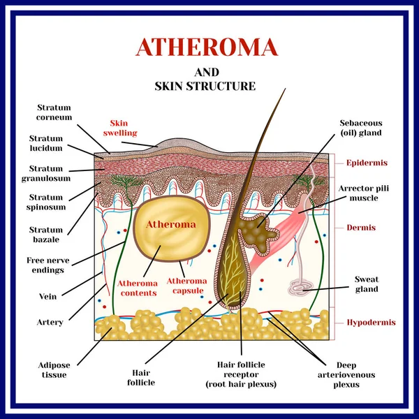 Ateroma. Cistos, tumores . — Vetor de Stock