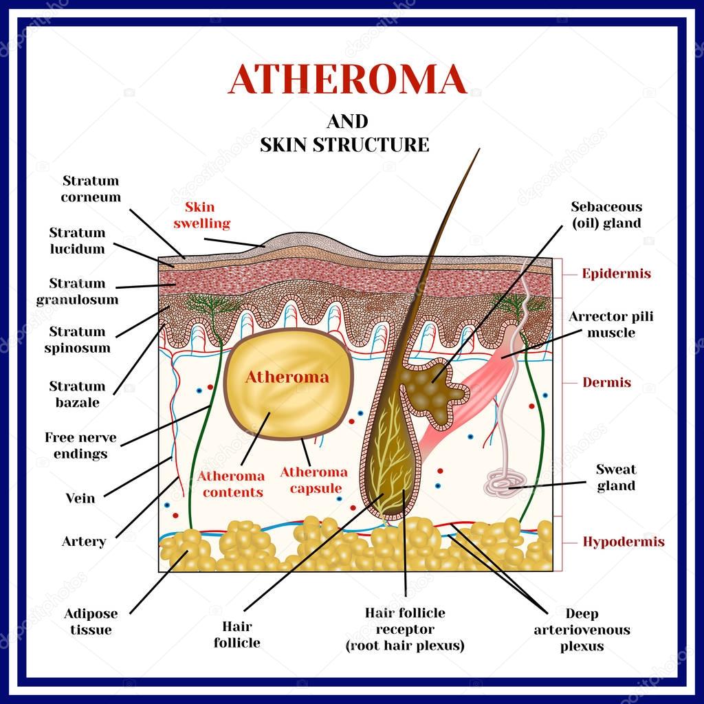 Atheroma. Cysts, tumors.