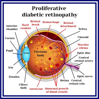 Types of diabetic retinopathy clipart