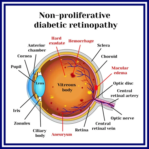 Tipos de retinopatia diabética — Vetor de Stock