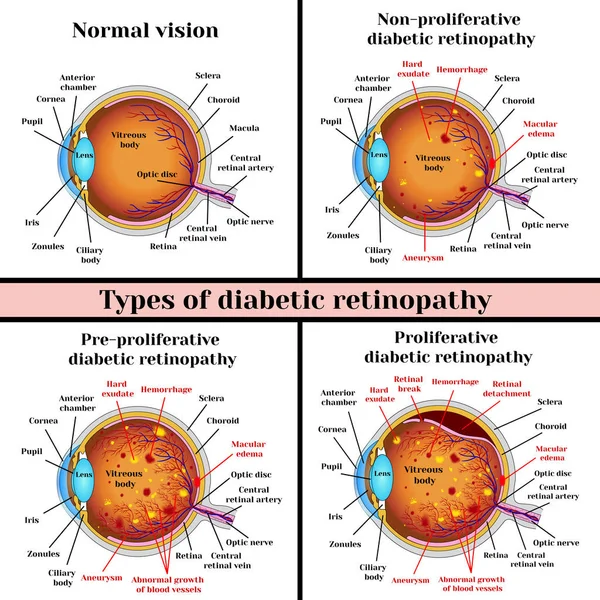 Tipos de retinopatia diabética —  Vetores de Stock