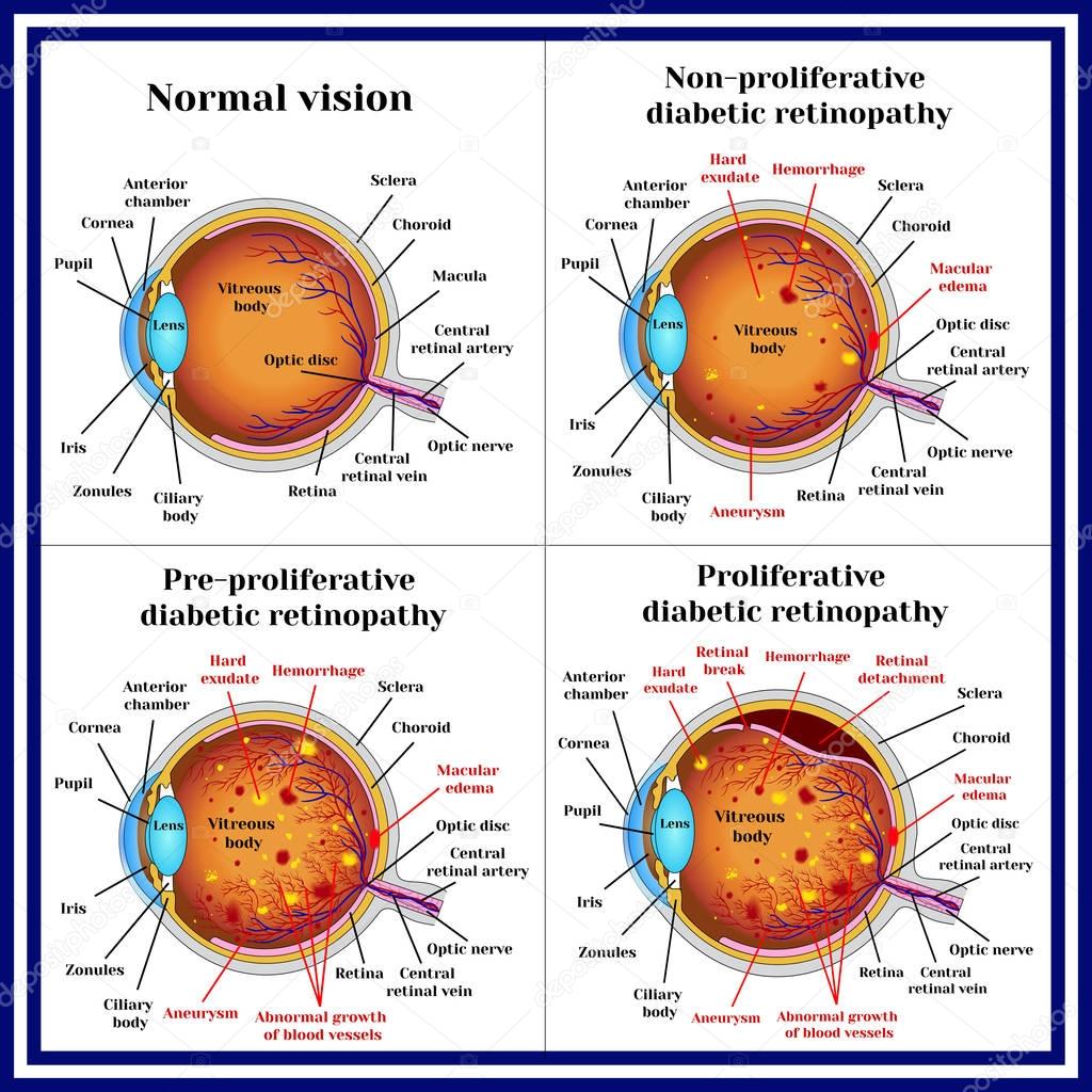 Types of diabetic retinopathy