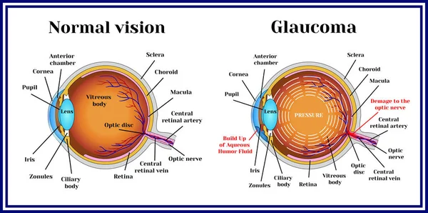 Visión normal. Glaucoma . — Vector de stock