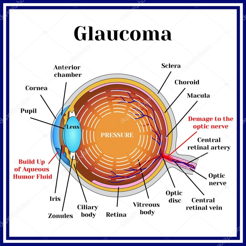 Normal vision. Glaucoma.